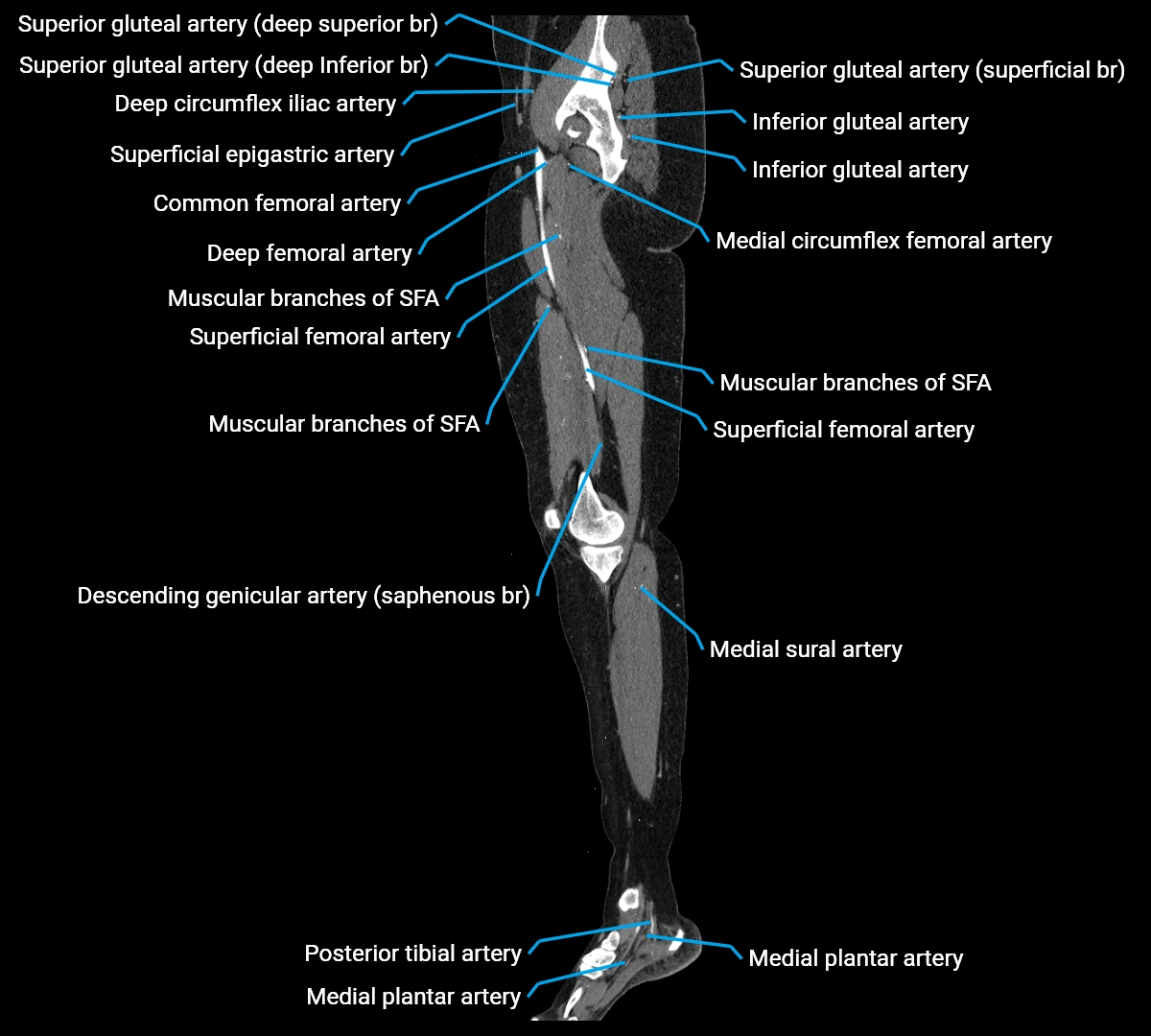 CTA lower limb sagittal cross sectional anatomy labelled image _31 (3).webp